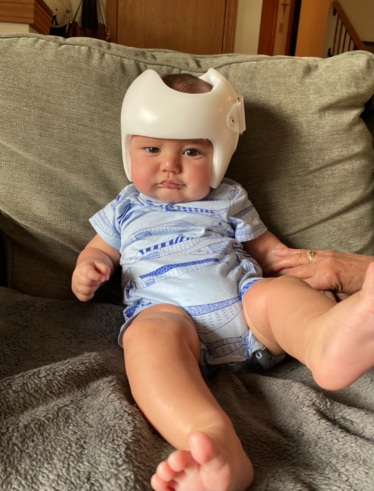 baby helmet therapy Don't Blink