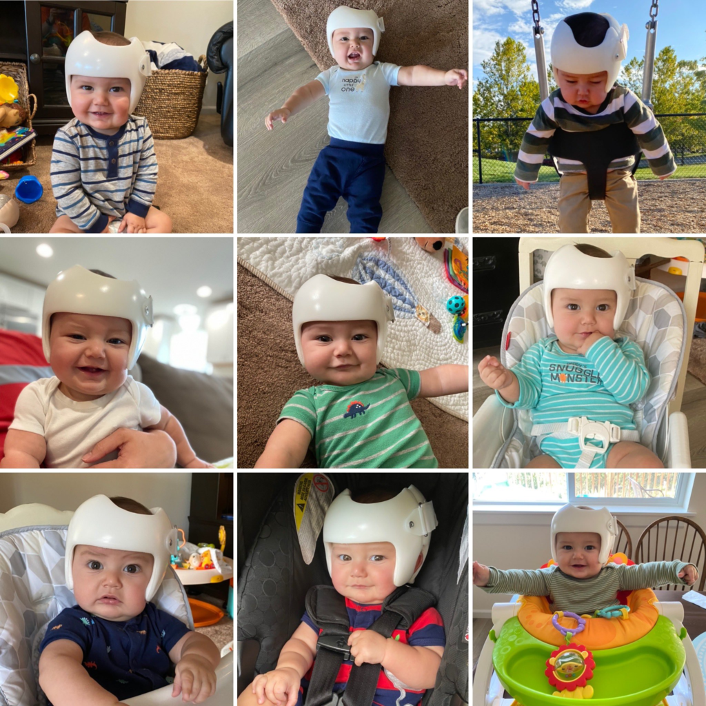 baby helmet therapy Don't Blink
