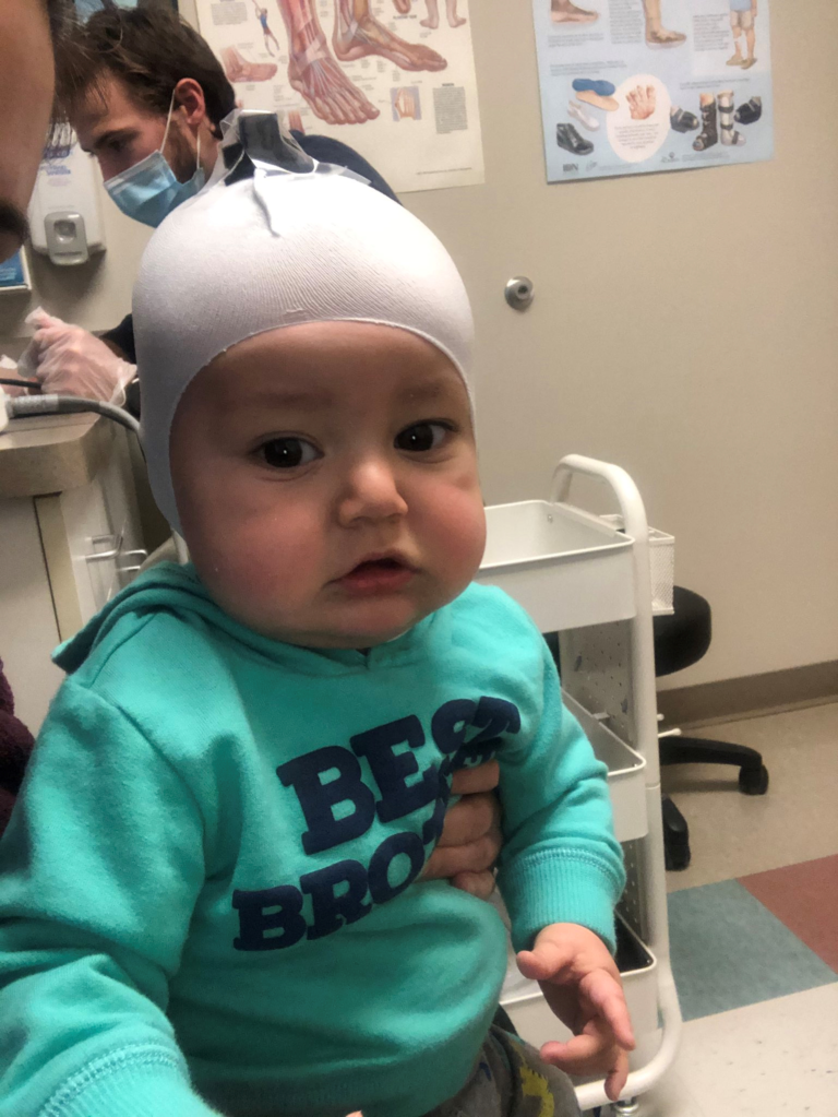 baby helmet therapy Don't Blink